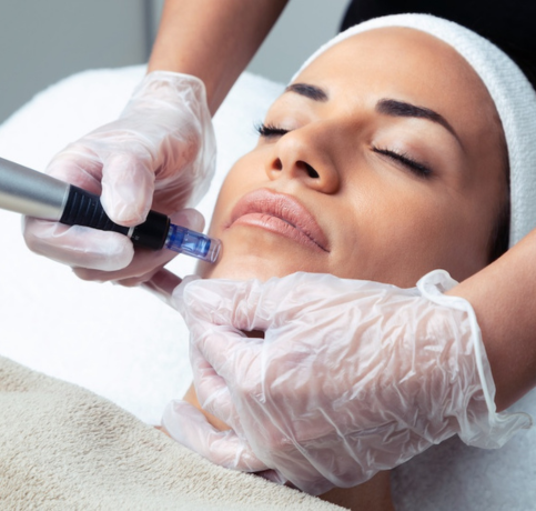 Client receiving microneedling facial treatment for skin rejuvenation and acne scars at Access Beauty 4U med spa in Frisco, Texas.